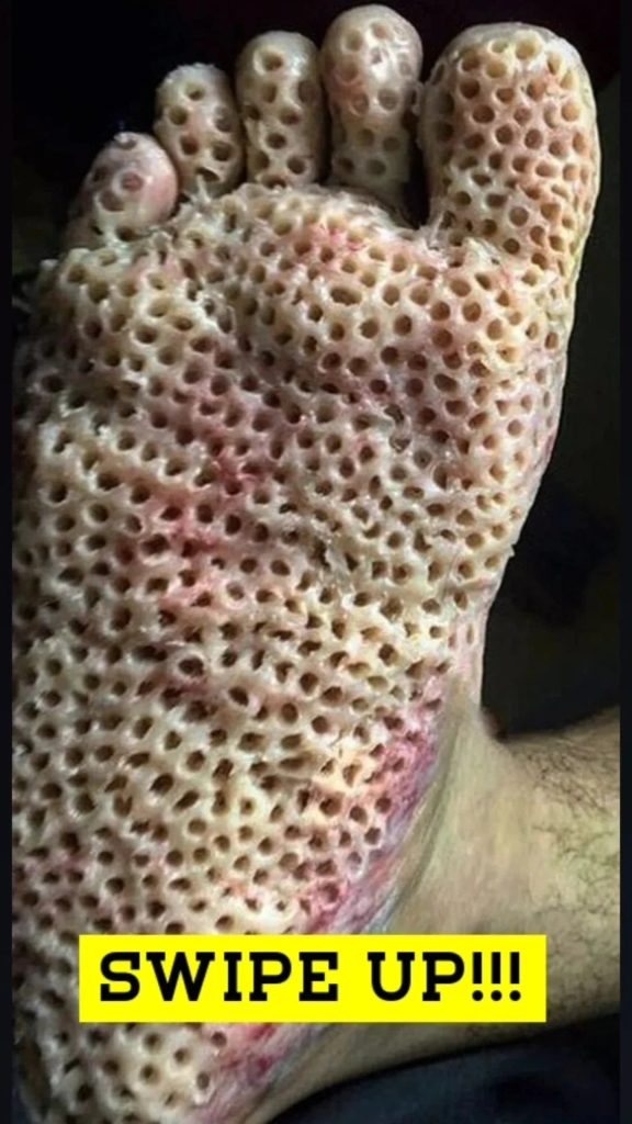 Trypophobia