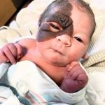 Mom wants to show 13-month-old daughter with rare birthmark that she is beautiful