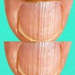 Having Striped Nails Could Mean That Your Body Is…