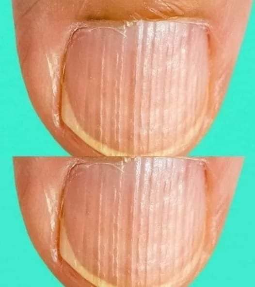 Having Striped Nails Could Mean That Your Body Is…