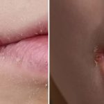 Warning issued to anyone who thinks they have ‘chapped lips’ as the weather turns colder