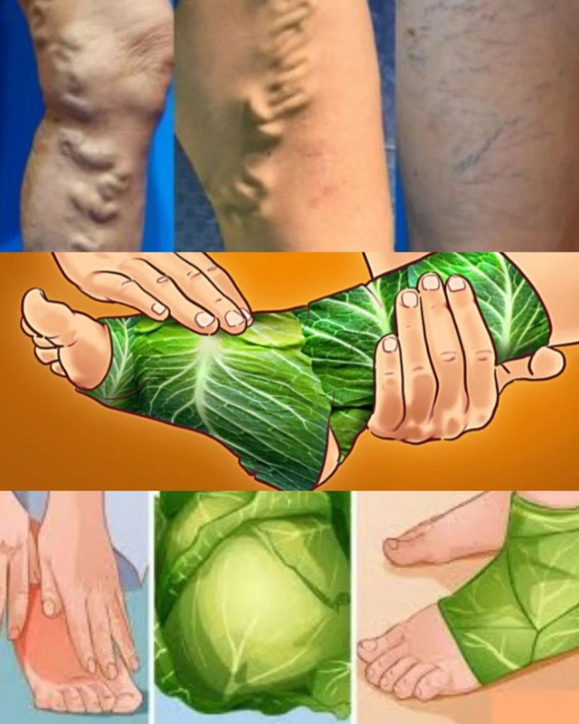 Amazing! Get Rid of Varicose Veins – Just Put These Leaves Over and Wait!